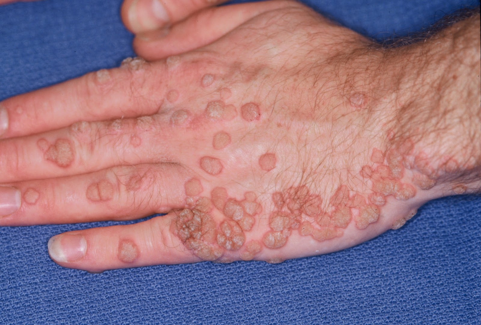 papillomavirus na pele