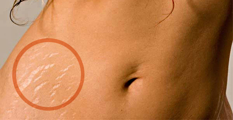 As estrias podem aparecer em qualquer parte do corpo onde a pele for esticada, mas são mais frequentes em áreas que tendem a armazenar gordura, como o abdômen, tórax, braços, nádegas e coxas. (imagem stockthink)