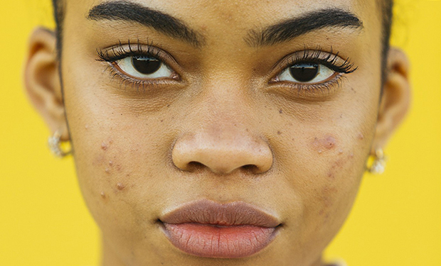 Acne adulta cresce na pandemia | Clinica Leas Peaux | Revista Marie Claire - Imagem: Getty Images